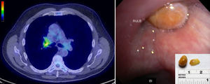 Left panel shows a PET-CT image with an endobronchial lesion in the right upper lobe bronchus with FDG-avidity (SUVmax 4.3). Right panel shows a bronchoscopic image of the right upper lobe endobronchial lesion, and an image of the corn kernel after removal (inset). RULB, right upper lobe bronchus; BI, bronchus intermedius.