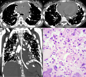 Axial computed tomography images at the level of the bronchial bifurcation (A) and lower lobes (B), and a coronal reformatted image (C) showing several calcified nodules in the subpleural regions and along fissures. Note also mediastinal lymph node calcifications and pericardial effusion. (D) Histological section showing proliferation of neoplastic cells with bone tissue formation. Note also nuclear atypia (hyperchromasia and karyomegaly) (hematoxylin and eosin stain, ×400).
