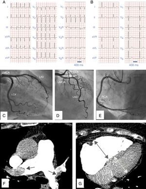 (A) Twelve-lead electrocardiogram in atrial fibrillation showing ST-segment elevation in leads III, AVF, AVR and V1 with ST-segment depression in I and AVL indicating inferior myocardial infarction. There is also ST-segment elevation in right precordial chest leads V4R, V5R and V6R demonstrating right ventricular involvement. (B) Twelve-lead electrocardiogram some months before, in sinus rhythm, with no ST-segment disturbances. (C) Coronary angiography with no significant lesions in left circumflex coronary artery (LCX), (D) left main coronary artery (LMCA), left anterior descending artery (LAD). (E) right coronary artery (RCA). (F) CT-pulmonary angiography revealing bilateral pulmonary embolism. (G) CT-pulmonary angiography with dilated right ventricle.