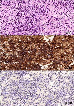 Immunostaining showing lymphoma cells on haematoxylin–eosin staining (upper part of image), presence of CD20 positive cells (middle part of image) and absence of HHV-8 (lower part of image).
