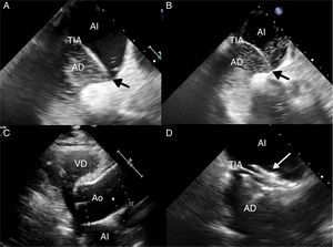(A) Transesophageal echocardiogram with contrast medium (agitated saline) in a lying position, showing passage of few bubbles from the right atrium (AD) to the left atrium (AI) across the patent foramen ovale (black arrow), enhanced by the leftward shift of the intraatrial septum (TIA). (B) Transesophageal echocardiogram with contrast medium performed in a sitting position. The passage of a greater quantity of bubbles is observed, demonstrating the increased right–left shunt. (C) Transthoracic echocardiogram showing marked dilation of the aortic root (Ao), an anatomical condition associated with platypnea-orthodeoxia. (D) Transesophageal echocardiogram showing the patent foramen ovale closure device (white arrow).