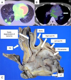 PET/CT showed FDG uptake in multiple lung nodules (A), but not in PA aneurysm (B). The thin arrow indicates PA aneurysm (B). Macroscopic findings from the specimen obtained by autopsy revealed PA leiomyosarcoma with cystic degeneration (C). PA, pulmonary artery; LA, left atrium; RA, right atrium.