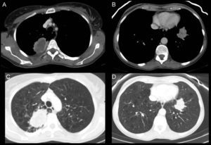 (A and C) Axial CT slices in the mediastinal and lung windows, respectively. A solid mass 6cm×4cm with infiltrative margins, containing necrosis, and peripheral enhancement in the posterior segment of the RUL adjacent to the posterior pleura. (B and D) Axial CT slices in the mediastinal and lung windows. Another solid lesion is seen in the LLL, adjacent to the diaphragmatic pleura, with infiltrative contours and less necrosis. (E and F) Axial CT slices in lung window, 6 months after starting bevacizumab treatment. In E, the RUL lesion can be seen to be larger, cavitated and with no solid component, and in F, the solid tumor in the LLL is smaller with lower attenuation than in images B and D.