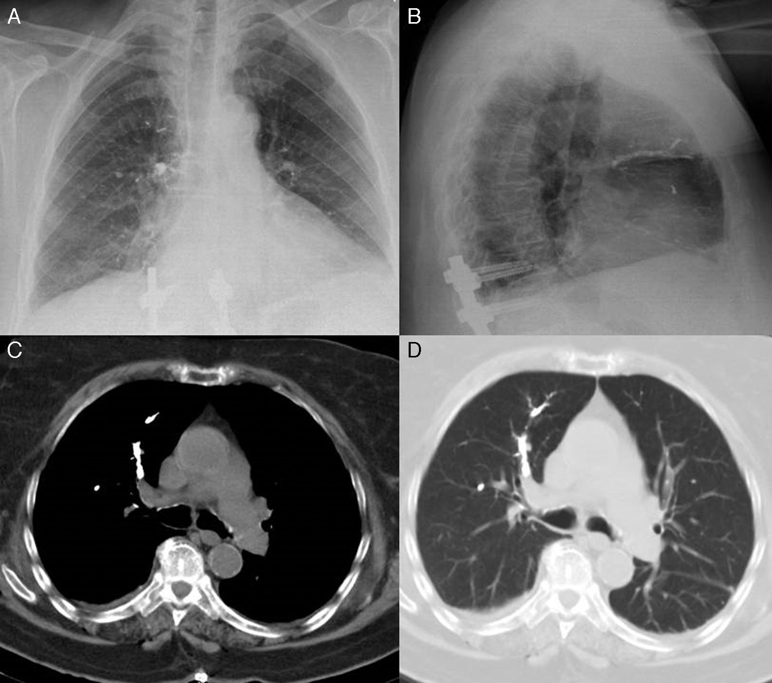 An Unusual Cause of Pulmonary Embolism | Archivos de Bronconeumología