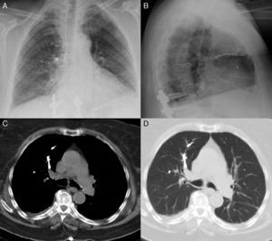 Posteroanterior (A) and lateral (B) chest radiographs with dense ramified material, associated with cement emboli, in the right upper, middle and lower lung fields and the left middle field. On the chest CT cross-sectional slice (C and D), the same material occupies right upper lobe segmental arteries.