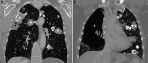 (A) Coronal reconstruction of chest CT (pulmonary parenchymal window) showing multiple nodules in both lungs (white asterisks). Note a subpleural cavitating lesion in the right lung (black asterisk). (B) Coronal reconstruction of chest CT (pulmonary parenchyma window, more anterior plane than image A), showing anterior loculated pneumothorax in right hemithorax (asterisk).