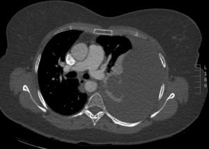 CT slice showing pleural hemangioma.