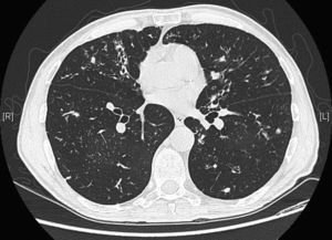 Bronchiectasis in the middle lobe and lingula associated with mucus plugs and distal centrilobular nodes.