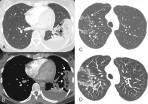 (A and B) A 32-year-old woman with acute pulmonary embolism and pulmonary infarction. Transverse contrast-enhanced CT images with lung (A) and mediastinal (B) window settings show an oval, subpleural reversed halo sign in the lateral segment of the left lower lobe of the lung (arrows). Note the reticulation inside the halo. A posterior atelectasis is also visible, outlined against a pleural effusion. The patient had clots involving several segmentary and non-segmentary pulmonary arteries (not shown). (C and D) A 39-year-old woman with active pulmonary tuberculosis. Axial CT image of the right upper lobe (C) shows a reversed halo sign with nodular walls. Axial reformatted image with maximum intensity projection (D) shows the nodules in greater detail (arrows).