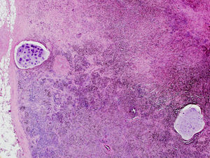 (HEOS 10×): Biopsy of lower right paratracheal node obtained by lymphadenectomy showing anthracotic pigment in macrophages, and containing two fragments of cartilage.