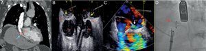(A) Chest computed tomography with contrast medium: right atrial compression due to elevation of the ipsilateral hemidiaphragm (blue arrow). (B and C) Transesophageal echocardiogram: right-to-left shunt through the foramen ovale (passage of contrast medium to the left atrium – yellow arrow; color-Doppler – white arrow). (D) Amplatzer® device (red arrow). AD: right atrium; AI: left atrium; Ao: ascending aorta; VCI: inferior vena cava.