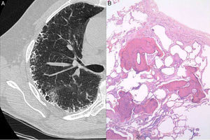 (A) CT scan showing subpleural calcified septal thickening, often with a serpiginous or branching appearance. (B) Irregular, branching, slender tubules of bone tissue within the lung interstitium, surrounded by fibrosis with fibroblastic foci.
