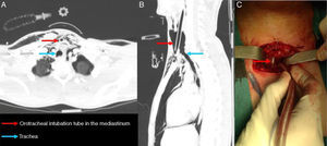 (A) Axial computed tomography (CT) slice. (B) Sagittal CT slice. (C) Surgical image with intraoperative distal intubation.
