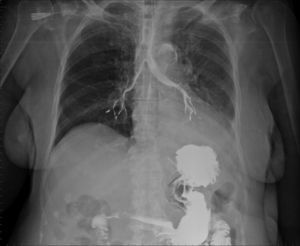 Radiological image of small bowel follow-through showing the incidental finding of contrast medium passing into the tracheobronchial tree.