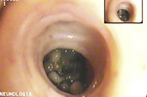 Bronchoscopic image of the left upper lobe segmentary bronchus resembling pebbles.