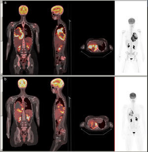Coronal, sagittal and axial slices of PET-CT fusion imaging. (a) A large mass is observed occupying almost all the right hemithorax, with heterogeneous density and highly intense peripheral uptake (SUVmax=18.9), in contact with the parietal pleura, posterior mediastinum and right hilum. (b) Reduced metabolic uptake (SUVmax=16.8) seen after chemotherapy.