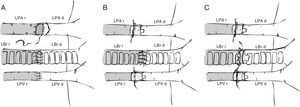 Surgical techniques in mouse model lung transplantation. (A) Vascular and bronchial anastomosis with sutures. (B) Bronchial anastomosis with sutures and use of vascular cuffs in the pulmonary vein and artery. (C) Vascular and bronchial anastomosis using cuffs. LBr d: left bronchus of donor animal; LBr r: left bronchus of recipient animal; LPA d: left pulmonary artery of donor animal; LPA r: left pulmonary artery of recipient animal; LPV d: left pulmonary vein of donor animal; LPV r: left pulmonary vein of recipient animal.