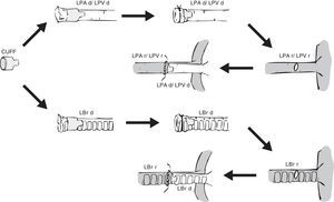 Placement of a cuff in the donor lung and anastomosis with the recipient lung. LBr d: left bronchus of donor animal; LBr r: left bronchus of recipient animal; LPA d: left pulmonary artery of donor animal; LPA r: left pulmonary artery of recipient animal; LPV d: left pulmonary vein of donor animal; LPV r: left pulmonary vein of recipient animal.