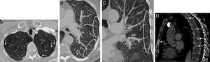 (A) Axial image of chest CT (pulmonary parenchymal window) showing linear thickening of the subpleural lung interstitium (arrows). (B) Maximum intensity projection (MIP) axial reconstruction (pulmonary parenchymal window) of left lung, showing a peripheral “tree-in-bud” pattern consisting of linear opacities forming predominantly subpleural branches (circled). See also the presence of small centrilobular nodules (arrow). (C) MIP coronal reconstruction (pulmonary parenchymal window) of the left lung, also showing the “tree-in-bud” pattern (circled). (D) Chest CT sagittal image (bone window) revealing multiple focal bone lesions (arrows) in the sternum and several vertebrae, consistent with bone metastases.