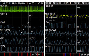 Screenshot obtained during ventilation adaptation. (A) The deflection mentioned in the text can be observed (arrow) and (B) resolution after setting a deceleration ramp of 250ms.
