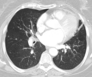 Multiple bilateral pulmonary nodules.