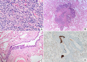 Photographic composition showing images of a carcinoid tumor (A, HE) with some fusocellular morphology, and no evidence of atypical cells, necrosis or significant mitotic activity; a tumorlet (B, HE) and intraepithelial neuroendocrine cell hyperplasia (C, HE and D, chromogranin immunostaining).