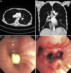 Top panel shows the axial (left) and coronal (right) appearance of the aspirated pill on CT chest. The bottom panel shows the bronchoscopic appearance of the pill (left) and the intense granulation tissue reaction seen after pill removal (right).