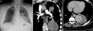 The chest X-ray showed opacity localized in the left hilar and paracardiac region (a, arrow). Computerized tomography pulmonary angiography (CTPA) showed 2 lesions, originating from upper and lower branches of the left pulmonary artery (b, arrow). Contrast filling was enhanced at late phase of imaging (c, asterisk), with small air bubbles at the periphery of the lower lesion (c, arrow).
