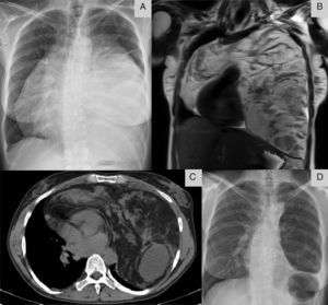 (A) Chest X-ray (posteroanterior) revealed a large opacity obscuring the heart border (silhouette sign). (B and C) Chest MRI and CT showing a large heterogeneous mass overlying the heart. (D) Chest X-ray (posteroanterior) after surgical excision showing lung expansion.
