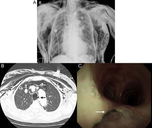 (A) Pneumothorax and subcutaneous emphysema of the chest. (B) Lower tracheal defect (black arrow). (C) Rupture (white arrow) of lower posterior wall of the trachea.