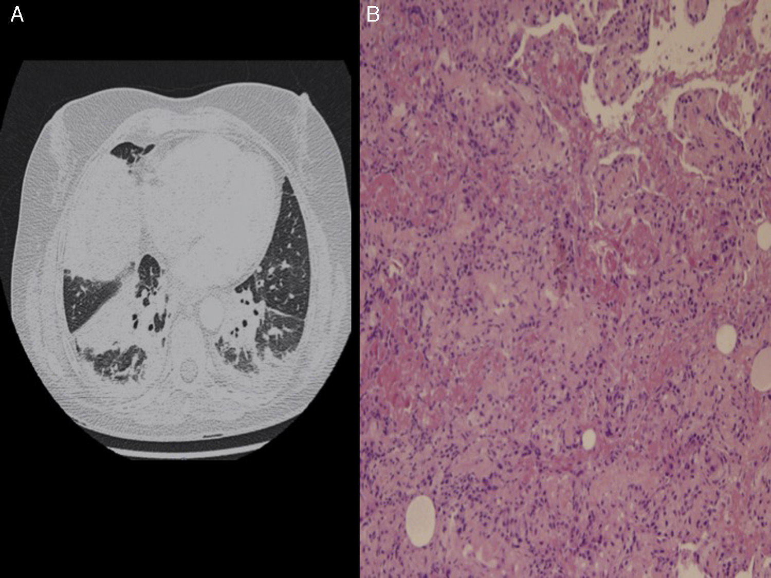 An Unusual Cause of Adult Respiratory Distress | Archivos de ...