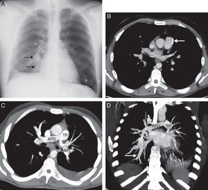 (A) Posteroanterior chest radiograph, showing increased caliber of arteries in the right lung base (arrows). Note the oligemia in the left lung compared to the right. (B) Axial image of chest CT, showing a calcified atheromatous plaque (arrow) in the wall of the pulmonary artery trunk. (C) Axial maximum intensity projection (MIP) reconstruction of chest CT, showing stenosis of the main pulmonary arteries, particularly in the left side (right main pulmonary artery [APD]; left main pulmonary artery [API]; pulmonary artery trunk [TP]). (D) Coronal MIP reconstruction of chest CT showing segmental artery in right lower lobe (arrow) of larger caliber than the APD (APD, TP).