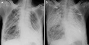 Chest X-ray images before (A) and immediately after (B) pleurodesis in case 1.