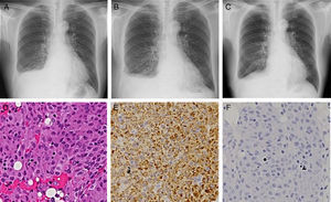 Chest X-ray images at the first visit to our department (A), three weeks after pleural biopsy (B), and two weeks after interruption of dasatinib (C). Hematoxylin–eosin-stained microscopic image (D; 200× magnification) and immunohistochemical microscopic images with the antibodies against CD68 (E; 200×), and S-100 (F; 200×).