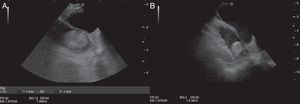 (A and B) Round hyperechoic image in the left atrial appendage.