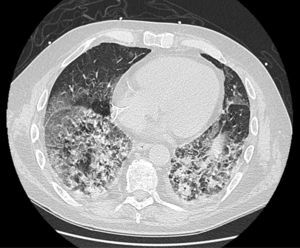 CT during admission, showing significant parenchymal involvement, compared to the previous normal CT, obtained one month previously at the end of the last chemotherapy cycle.