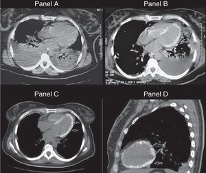 Panel A. Tomography performed on admission showing bilateral pleural effusion and pulmonary consolidation. Panel B. Similar tomography slice obtained 7 days later, revealing calcified ventricular myocardium. Panels C and D. Extensive calcification throughout the left ventricular myocardium (day 30).