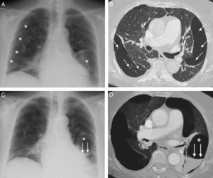 (A) Chest radiograph, showing multiple subpleural cystic formations (asterisks) in both lungs. (B) Axial image of chest CT (lung window), showing multiple converging cystic lesions in the periphery of both lungs. Note the presence of small pulmonary vessels (arrows) traversing the cystic formations. (C) Chest radiograph identifying an air-fluid level (arrows) in a cystic lesion in the left lung base (asterisk). (D) Minimum intensity projection (miniIP) axial reconstruction, showing the air-fluid level (arrows) corresponding to bleeding in the interior of a cystic lesion (asterisk) in the left lower lobe.