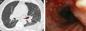 Chest CT (a) and bronchofibroscopy (b) revealing osteocartilagenous nodules in the anterior wall of the trachea. Lung centrilobular nodules and a left pleural effusion can also be seen on Chest CT (a).