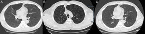 CT images showing a large bulla in the RUL (A), spiculated pulmonary nodule in the RUL, along with resolution of the large bulla in this region (B), and the image after surgical resection of the pulmonary nodule with continued absence of the large emphysematous pulmonary bulla (C).