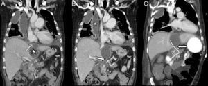(A and B) Coronal reconstructions of CT in a 47-year-old patient with a history of chronic pancreatitis complicated by a thoracopancreatic fistula. CT shows a loculated pleural effusion (star in B) connecting (arrow in A) with the pseudocyst (star in A), which in turn connects with the pancreatic duct (arrow in B). (C) Follow-up CT performed at 12 days, after ERCP and prosthesis placement (arrow in C), draining the pseudocyst and pleural collection via the pancreatic duct to the duodenum.