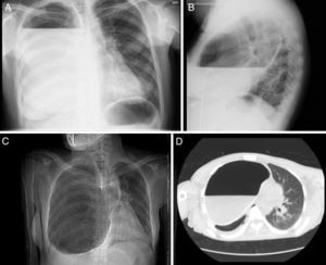 (A and B) Standard posteroanterior and lateral chest radiographs showing cystic lesion with calcified walls occupying practically all the right hemithorax containing an air-fluid level. (C and D) Chest computed tomography, showing that the cystic lesion was causing atelectasis of a large part of the pulmonary parenchyma of the right hemithorax and left mediastinal shift.
