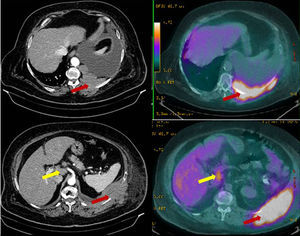 Positron emission tomography: hypermetabolic left pleural mass, with SUV(max) 10.3 consistent with primary neoplastic lesion (black arrows) and abdominal lymphadenopathies in the hepatic hilum, and retropancreatic and para-aortic lymphadenopathies, suggestive of tumor infiltration (white arrows).