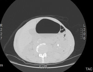 Abdominal computed tomography showing gas in the bladder and the bladder wall.