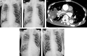 Chest X-ray images at admission (A) and 4 days after admission (B). Contrasted-enhanced chest computed tomography image (C). Chest X-ray Images 3 days (D) and 1 month (E) after embolization of the pulmonary artery.