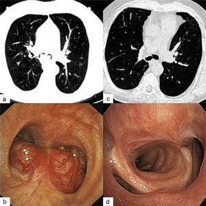 (a) Initial chest CT scan, (b) endobronchial mass occluding the main bronchi, (c) chest CT scan at reevaluation, and (d) tracheal view – from left to right: right upper bronchus, intermediate bronchus, carina and entrance to the left main bronchus.
