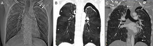 (A) Chest radiograph showing a loss of volume in both lungs and left pneumothorax (arrows). (B) Minimum intensity projection (minIP) coronal reconstruction of chest CT (pulmonary parenchyma window), showing geographical areas of low attenuation in both lungs (asterisks) associated with areas of air trapping. (C) Coronal image of chest CT (pulmonary parenchyma window) revealing bilateral pneumothorax (arrows).