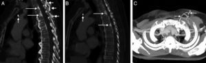 (A) Sagittal reconstruction of the chest CT with intravenous contrast medium showing focal sclerotic bone lesions in the posterior margin of the T2 and T3 vertebral bodies, mimicking vertebral metastases. Note the port catheter in the theoretical position of the thrombosed innominate vein (short vertical arrow) and the development of collateral venous circulation in the perivertebral veins (short horizontal arrows). (B) Sagittal reconstruction of the chest CT with intravenous contrast medium showing focal sclerotic bone lesions in the posterior margin of the T3 and T5 vertebral bodies (long arrows). Note the port catheter in the theoretical position of the thrombosed innominate vein (short arrow). (C) Maximum intensity projection axial reconstruction of CT, showing development of collateral venous circulation in the anterior chest wall (arrows).
