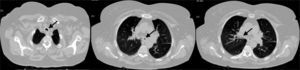 Chest CT showing tracheal and bronchial wall thickening and luminal narrowing.