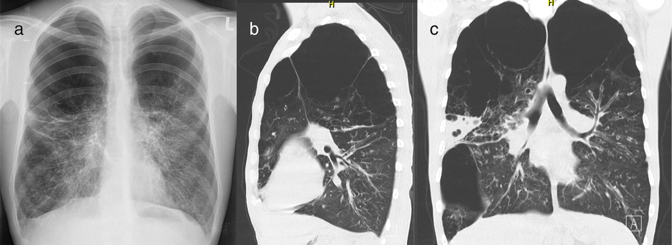 Vanishing Lung Syndrome in a Cystic Fibrosis Patient | Archivos de ...